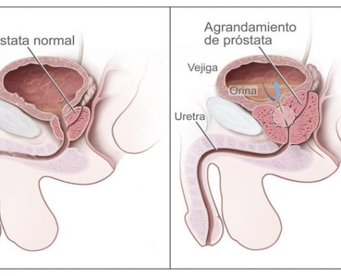 Situación de cáncer de próstata