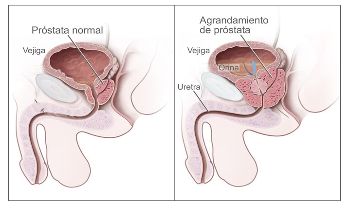 Prostatita. termene pentru eliberarea analizelor de sânge gata